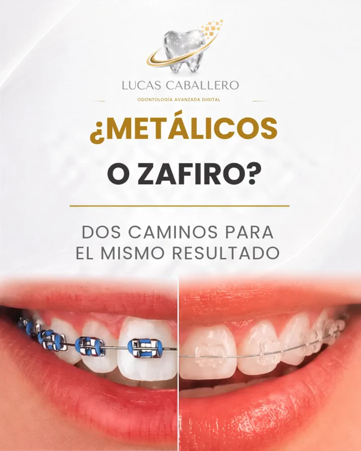Carrusel que compara brackets metálicos y de zafiro. Slide 1 de 5